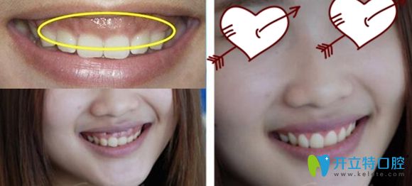 通过牙龈整形就可改善笑露牙龈症状