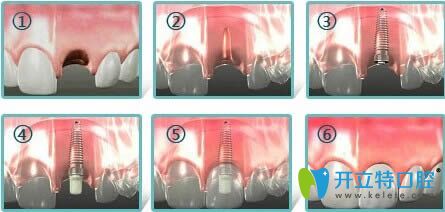 朱惠奇医生的专业讲解种植牙修复过程