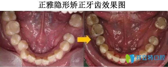 正雅隐形矫正牙齿的效果展示图