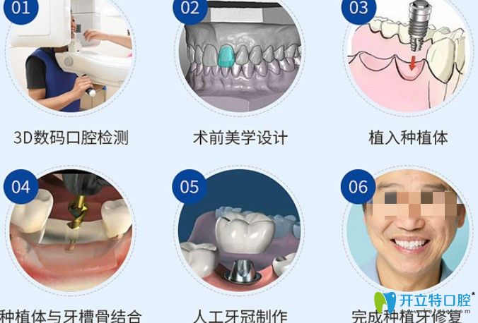 正夫口腔种植牙过程