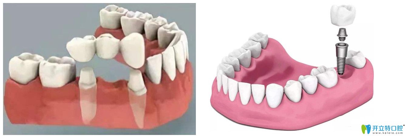 徐命松医生告诉大家：种植牙与传统假牙相比的优势