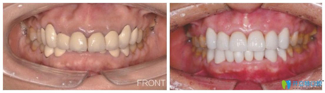 天哪!43岁在北京维乐口腔做个牙齿矫正顺便又修复了一下牙