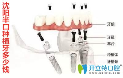 沈阳半口种植牙多少钱