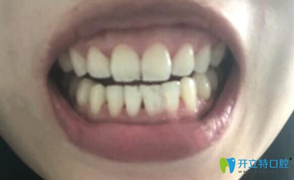 在济南维乐口腔做牙齿矫正1年8个月