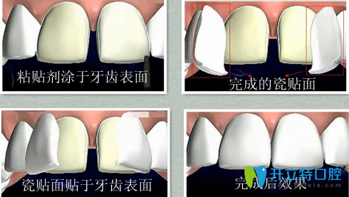 牙齿贴面的过程