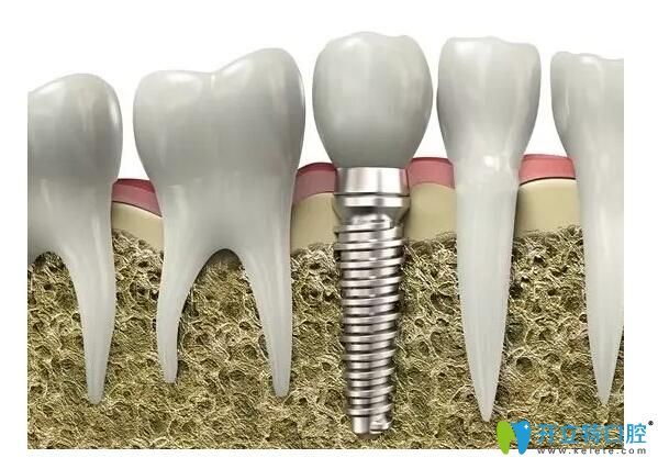 种植体品牌不同价格也不同