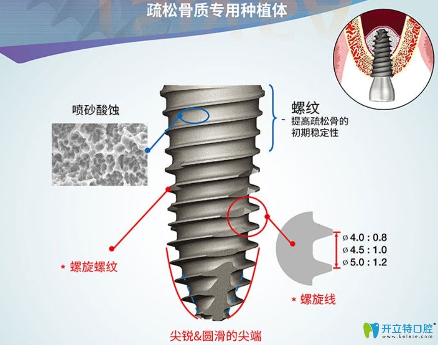 奥齿泰TSIV系列