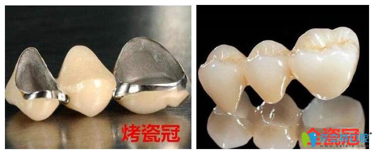 种植牙的牙冠不同