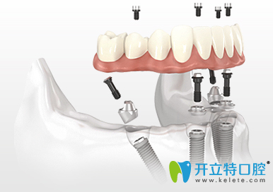 allon4半口种植牙