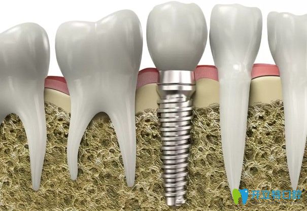 牙槽骨萎缩变薄可通过穿颧种植来解决