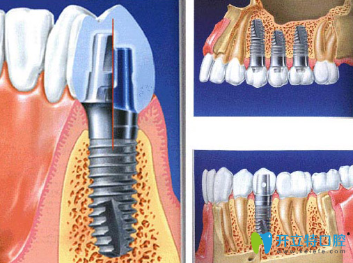 微创种植牙多少钱