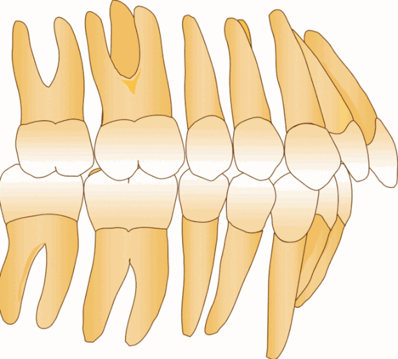 牙槽骨萎缩可通过种植牙来修复