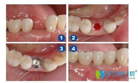 靖江艾齿嘉口腔陈涛医生介绍种植牙注意事项