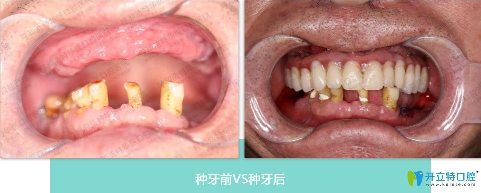 郑琛医生半口即刻负重种植案例效果分享