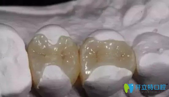 周雪莹医生解释瓷嵌体与传统补牙的区别