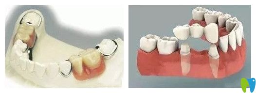 种植牙比传统假牙的优势