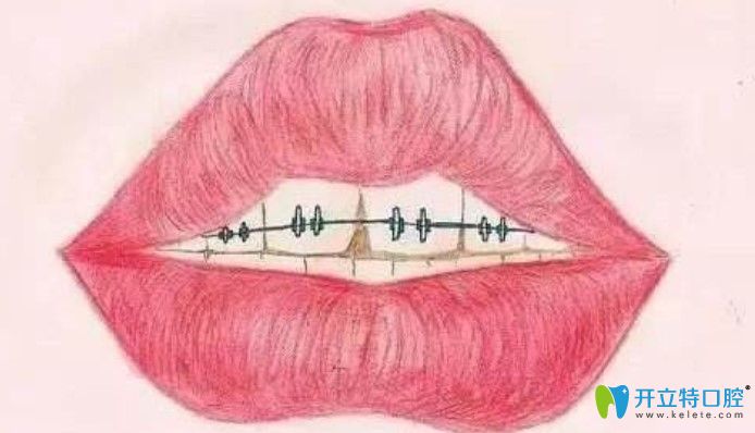 任蕾医生科普：牙齿矫正后反弹怎么办