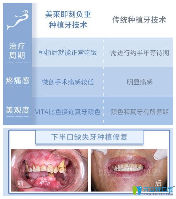 美莱口腔即刻负重种植牙优势多多，还有下半口牙缺失案例效果来证明