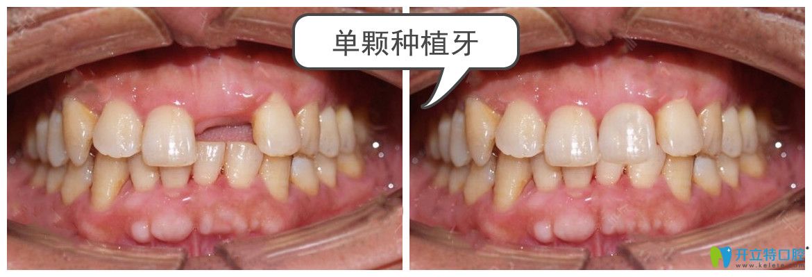 南京牙仙子口腔单颗种植牙案例