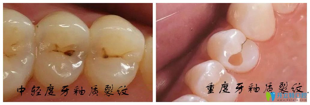 牙釉质裂纹不同程度的比较