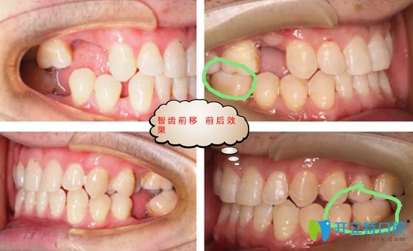 智齿前移代替种植牙的效果图