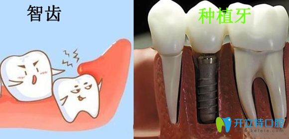 智齿和种植牙展示图