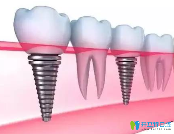韩国登腾种植牙很差吗? 韩国登腾种植牙很差吗?