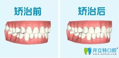 达芬奇隐形矫正前后对比 达芬奇隐形矫正前后对比
