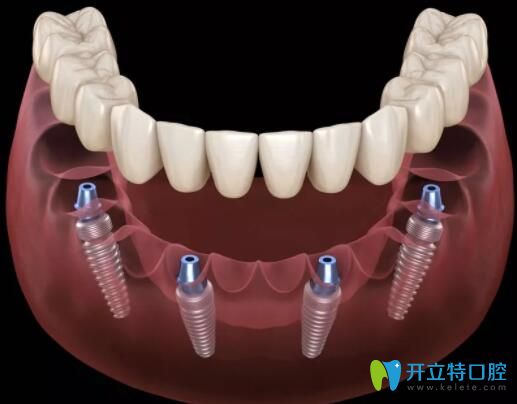 宁波恒美口腔allon4全口种植技术