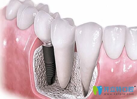 程龙医生告诉你：个别牙齿缺失用什么方式修复比较好
