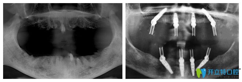 靖江艾齿嘉口腔allon4种植牙CT片