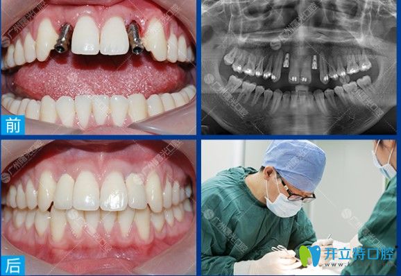 广州曙光口腔多颗种植牙前后对比图