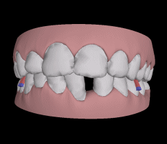 矫正过程中牙齿移动图示