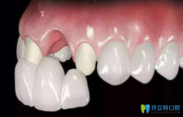 程龙医生告诉你：个别牙齿缺失用全瓷牙修复也可以