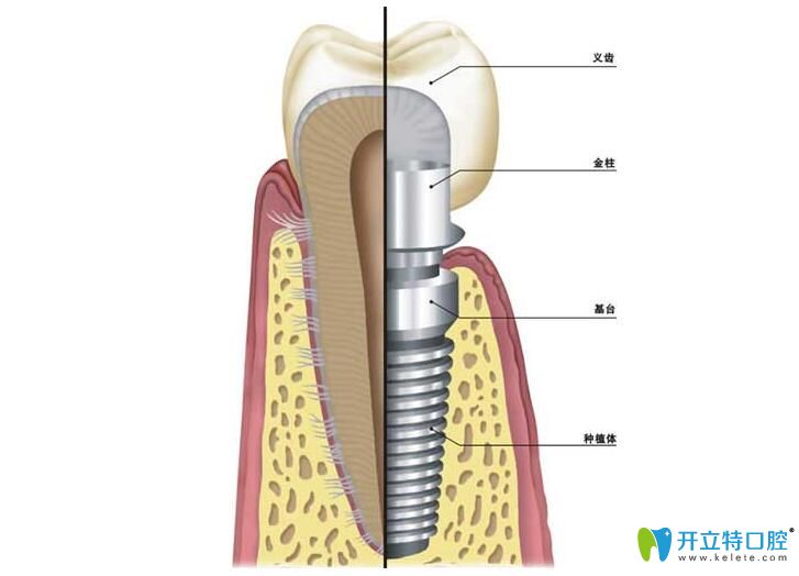 恒美口腔对于种植体、基台和牙冠的要求很高