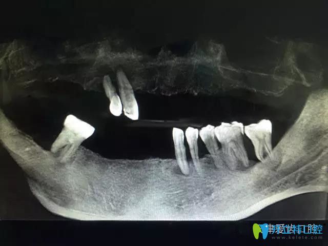 我在天津爱齿口腔做种植牙前CT片