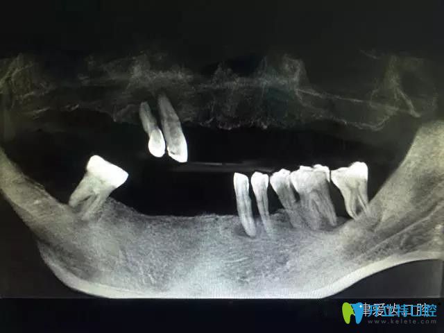 牙齿缺失在天津爱齿口腔做allon4全口种植牙当天长出