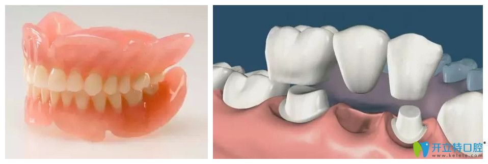 活动义齿和固定义齿的图片对比