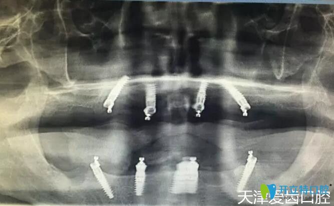 我在天津爱齿口腔做allon4全口种植牙术后CT片