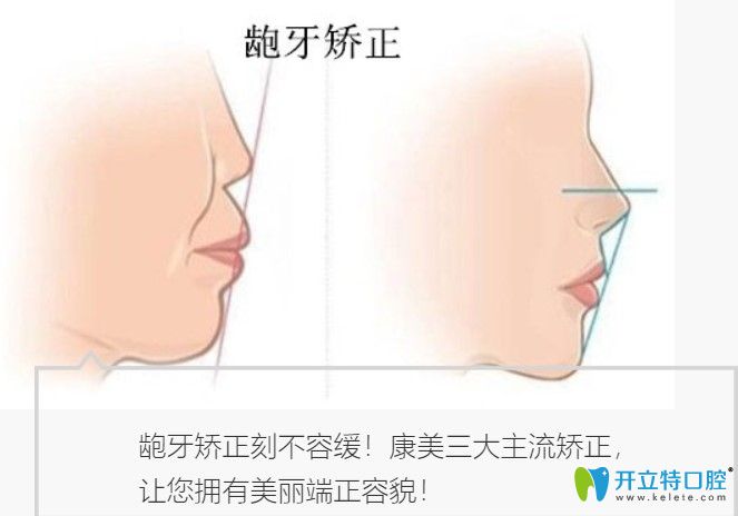 南京康美口腔龅牙矫正的方式