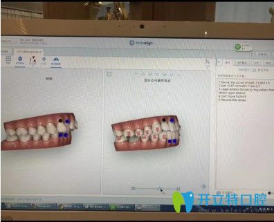 天津爱齿口腔袁新明医生介绍数字化快速矫正的优势