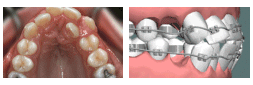 上海美乐口腔矫正牙齿过程图