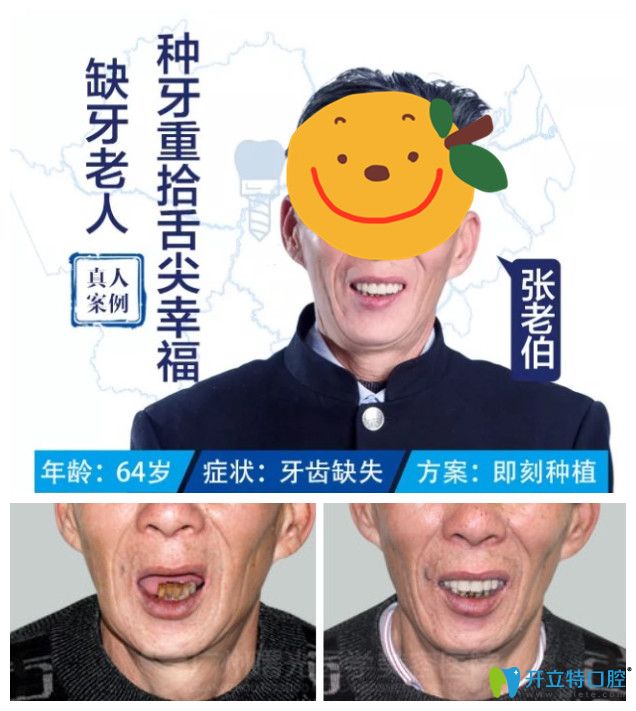 广州曙光种植牙案例分享 广州曙光种植牙案例分享