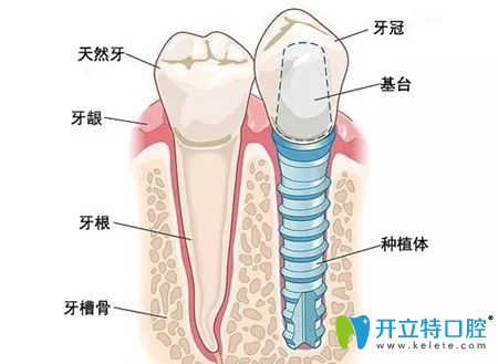  汪来琼医生表示种植牙为牙齿缺失的较好修复方式