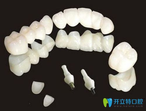 陶瓷牙怎么样 陶瓷牙怎么样