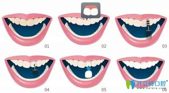 牙齿贴面步骤图