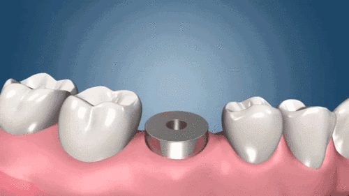 种植牙修复基台换愈合基台过程