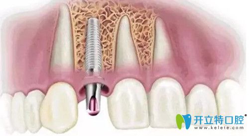 种植牙该怎么选择？