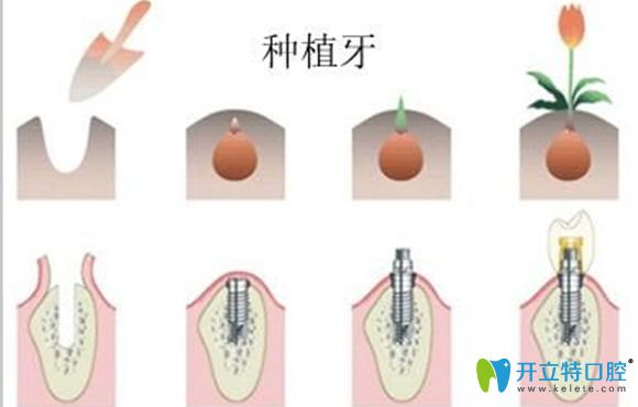 深圳侨诺口腔提醒大家种植牙后期也需我们好好维护