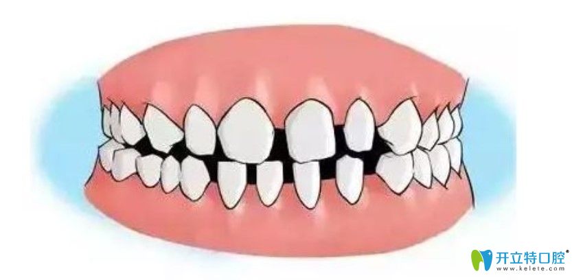 牙齿间隙过大也可在康美做正畸